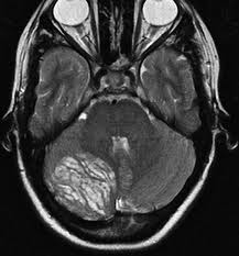 Magnetic resonance imaging of cerebral lesion in patients with sjogren's syndrom /l.e. Https Www 2013 Roentgenkongress De Media Document 3173 Rk Sp 102 1 Forsting Pdf