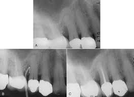 Cementum tear complete or partial detachment of a fragment of cementum from the root surface of a tooth, especially when associated with occlusal trauma. 4 Problem Solving In The Differential Diagnosis Of Bony Defects Resulting From Pulpal And Periodontal Pathosis Pocket Dentistry