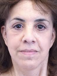 Festoon and Left Ptosis Repair 2982