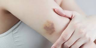 Hematoma Causes, Symptoms & Treatments | HemAware