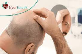 زراعة الشعر في تركيا تكلفة زراعة الشعر في اسطنبول زرعة الشعر على أنه hair transplant best hair transplant hair restoration