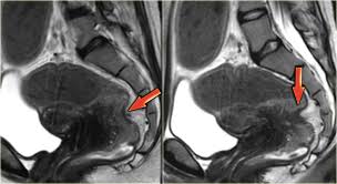 The endometriosis cells are in the ovaries during menstruation through the fallopian tubes. The Radiology Assistant Endometriosis Mri Detection