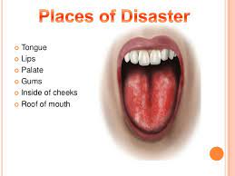 How To Manage Burning Mouth Syndrome Dr Sameer Shaikh Orthodontist Dentist Dubai