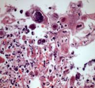 Trichinosis: clinicopathological case