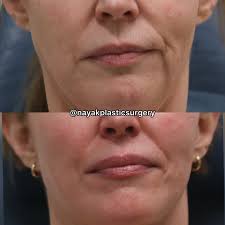 🤌🤌Plastic surgery doesn't have to look plastic. 😍😍Margot is 58 years  old. She is almost 4 months postop deep plane facelift, deep necklift, brow  lift, upper blepharoplasty, lower blepharoplasty, corner lip reset,