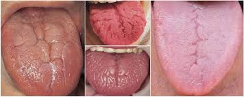 Image result for Fissured tongue
