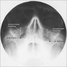 Image result for Sinusitis Prediction Rule