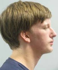 ALF, Twin Block, Straight Wire for Linear Scleroderma Treatment