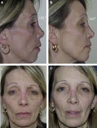 Rhinoplastie et injection de tissu adipeux autologue