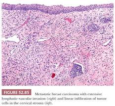 Make sure that the condom fits and is put on correctly. Cervix Basicmedical Key