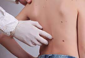 Skin cancer is the most common type of cancer in the united states by a pretty large margin, and it does not discriminate. Moles On Child S Body Signs Prevention Tips