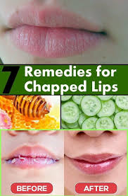 Chapped Lips Home Remedy Chapped Lips Chapped Lips Remedy Fast Dry Cracked Lips That Won T Heal H Dry Lips Remedy Treating Chapped Lips Chapped Lips Remedy