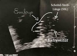 Wenn sie es schaffen, zu warten, bis auch ihre zweite regel ausgeblieben ist, sind sie in der achten schwangerschaftswoche. Dein Baby Im Ultraschall Mamiwiki
