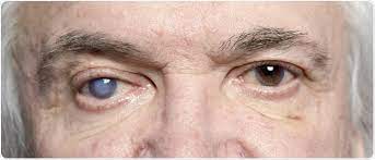Mar 19, 2021 · people who are over the age of 60: Signs And Risk Factors For Eye Disease