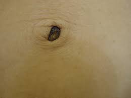 Image result for Umbilicus