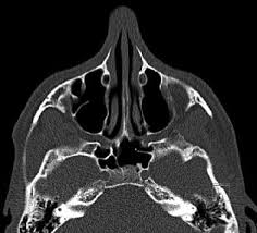 Image result for Sinus CT