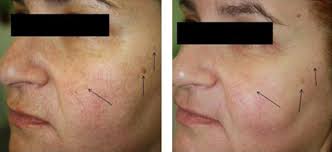 Jean michel jarre oxygene (part iv) (oxygene 1976). The Oxygeneo Oxygen Facial Is Like Three Skin Treatments In One The Skincare Edit
