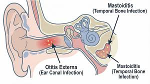 Image result for Otalgia
