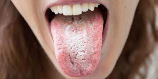 Namun begitu, tak semua punca bibir kering datang daripada sumber yang sama. Mulut Kering Punca Dan Cara Rawatan The Diagnosa