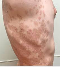 Image result for Postinflammatory Hyperpigmentation