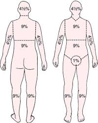 Rule Of Nines Definition Of Rule Of Nines By Medical Dictionary