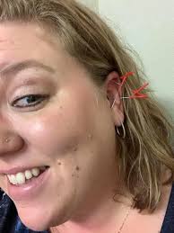 Acupuncture for back pain