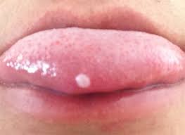 Image result for cancer of tongue