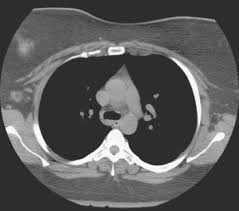 The scan is painless and usually takes between 5 to 30 minutes. Identifying Bone Metastases Clinical Gate