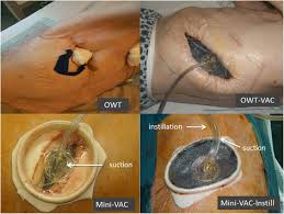 Physical examination shows a smooth red tongue. Short Term And Long Term Outcomes Of Intrathoracic Vacuum Therapy Of Empyema In Debilitated Patients Journal Of Cardiothoracic Surgery Full Text