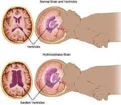 Hydrocephalus Penyakit Jenis