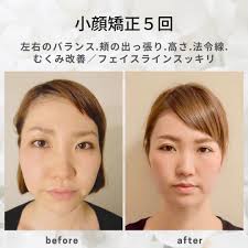 小顔矯正は続けないと元に戻る？ | 東京表参道青山渋谷【BITORIA】本格小顔骨盤美容矯正サロン