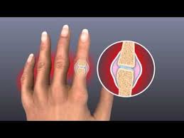 Exercises and stretches for instant neck pain relief. The Pain Swelling And Stiffness Of Rheumatoid Arthritis Youtube