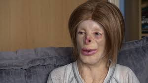 Suffolk teen who suffered burns as a baby is trolled