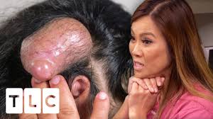 Sandra lee, also known as dr. Dr Lee May Have Extracted The Biggest Pillar Cyst She Has Ever Seen Dr Pimple Popper Pop Ups Youtube