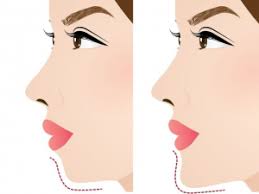 Chin Augmentation In Iran Affordable Chin Augmentation