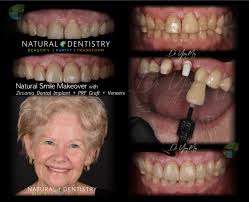 Top 10 best cosmetic dentists in new york, ny · lumia dental. Smile Makeover Zirconia Implant Veneers