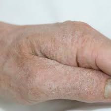 Human scabies is caused by an infestation of the skin by the human itch mite (sarcoptes scabiei var. Eleven Years Of Itching A Case Report Of Crusted Scabies Mdedge Dermatology