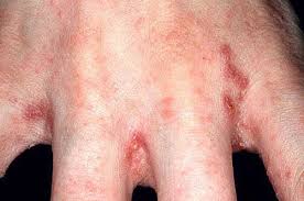 Image result for scabies in the groin area