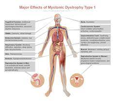 Myotonic Muscular Dystrophy Infant Google Search Myotonic Dystrophy Muscular Dystrophies Muscular Dystrophy Types