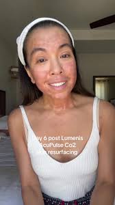 Day 6 post-CO2 laser Serving: Reptile shedding its skin but make it  skincare. The flaking is real, the pink is strong, and the white bumps are  trying to join the party—but we’re staying hydrated, ...