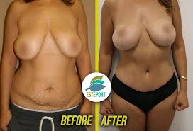 Breast Lift With Implants Turkey Cost 2024 - Dr. Ali Mezdeği