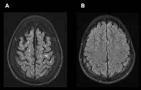 Multiple sclerosis (ms) is the most common chronic autoimmune disorder of the central nervous system (cns) largely affecting young adults. Projektionsneurone Fur Ms Spezifische Gehirnveranderungen Bedeutend