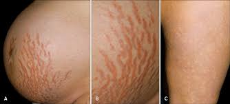 Image result for pruritic urticarial papules and plaques of pregnancy