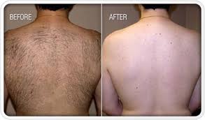 Consider Our Laser Hair Removal Services For-At DCS Laser & Skin Care Center