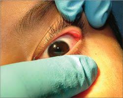Check spelling or type a new query. Conjunctival Pyogenic Granuloma