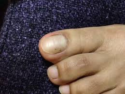 We did not find results for: Black Spot Under Toenail