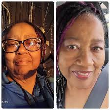 Face to face! About a month pre surgery (4/15) and the second is 2 months  after (6/15)