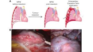 We did not find results for: Malignant Pleural Mesothelioma From Bedside To Bench And From Bench To Bedside