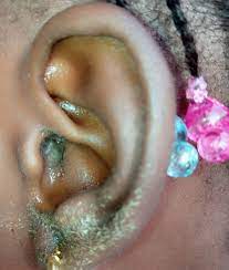 How to Treat Ear Infections from Home : BusinessHAB.com