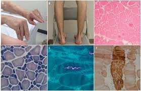 Image result for Myopathy